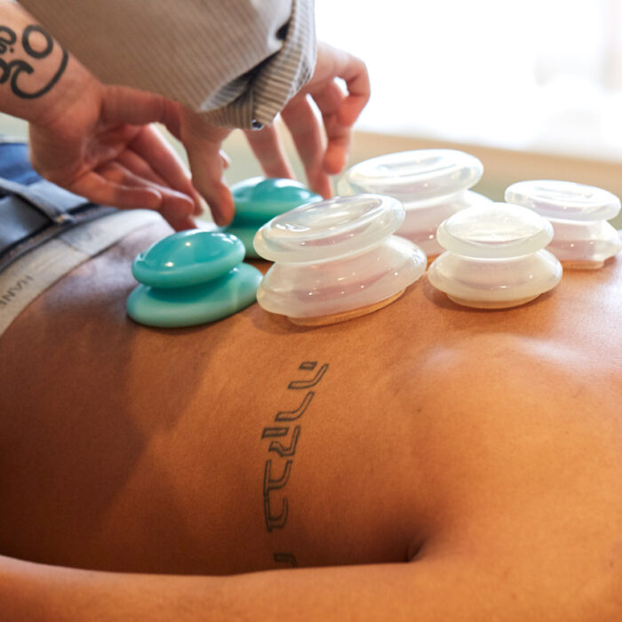 Cupping – a modern twist on an ancient therapy