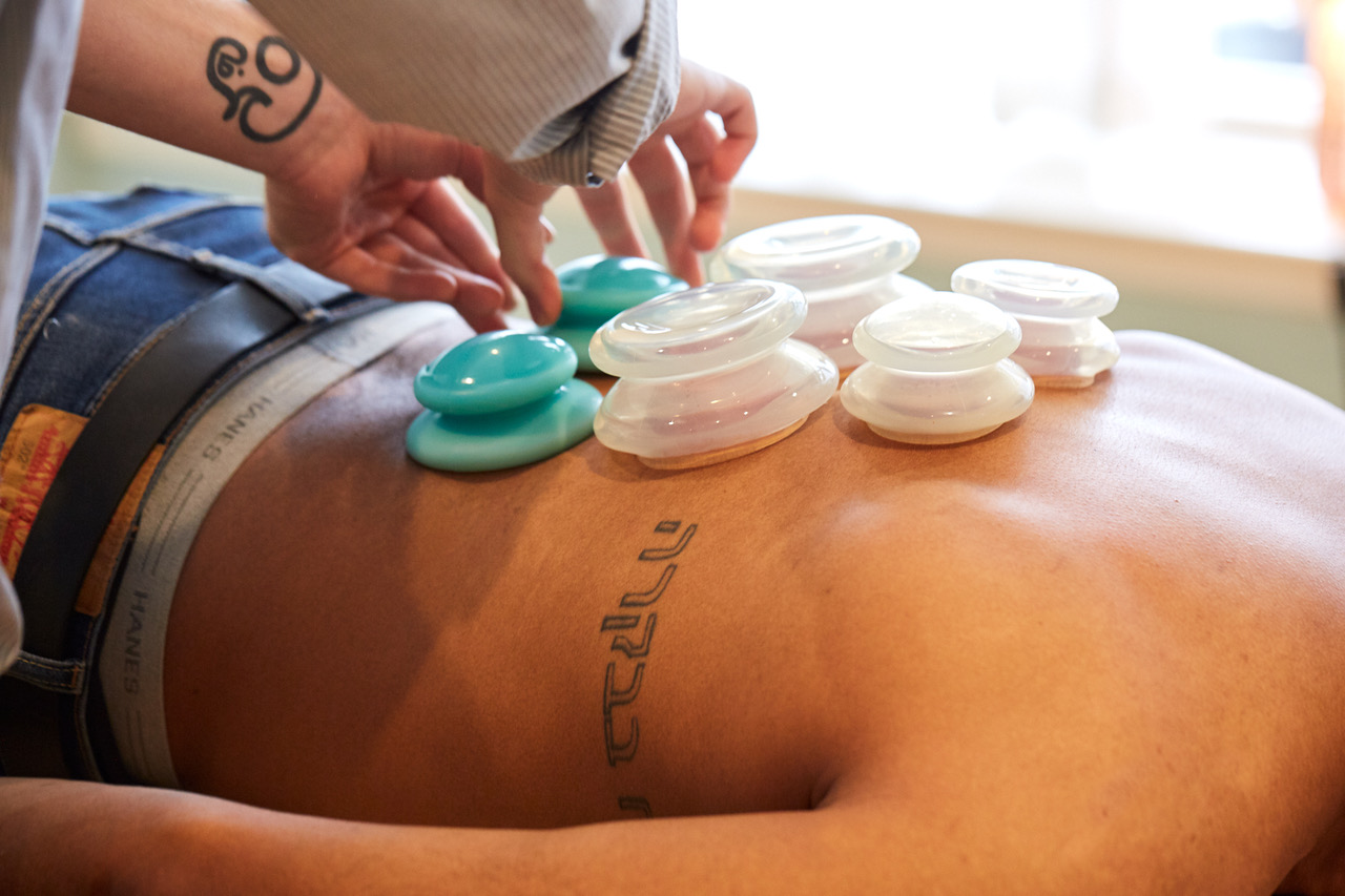 Cupping – a modern twist on an ancient therapy