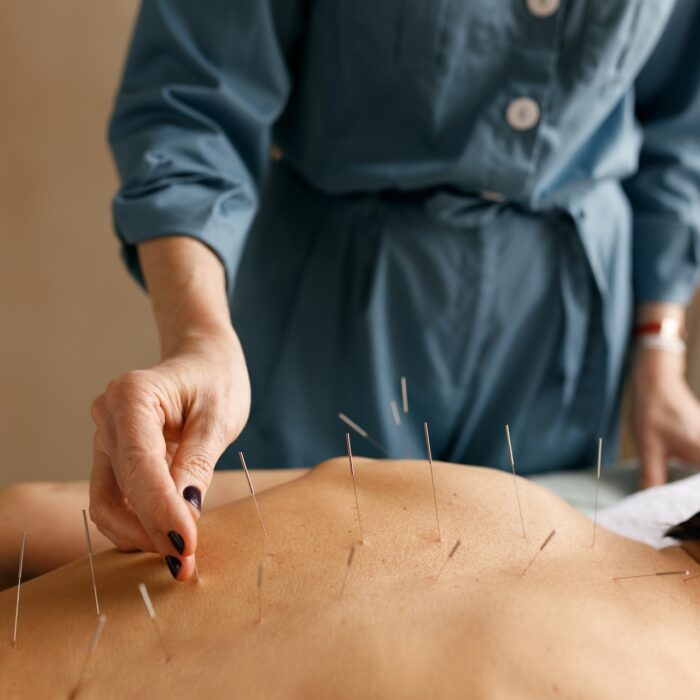 Acupuncture for Pain Relief: What Your Body’s Trying to Tell You